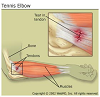 Common Tennis Injuries Common Tennis Injuries